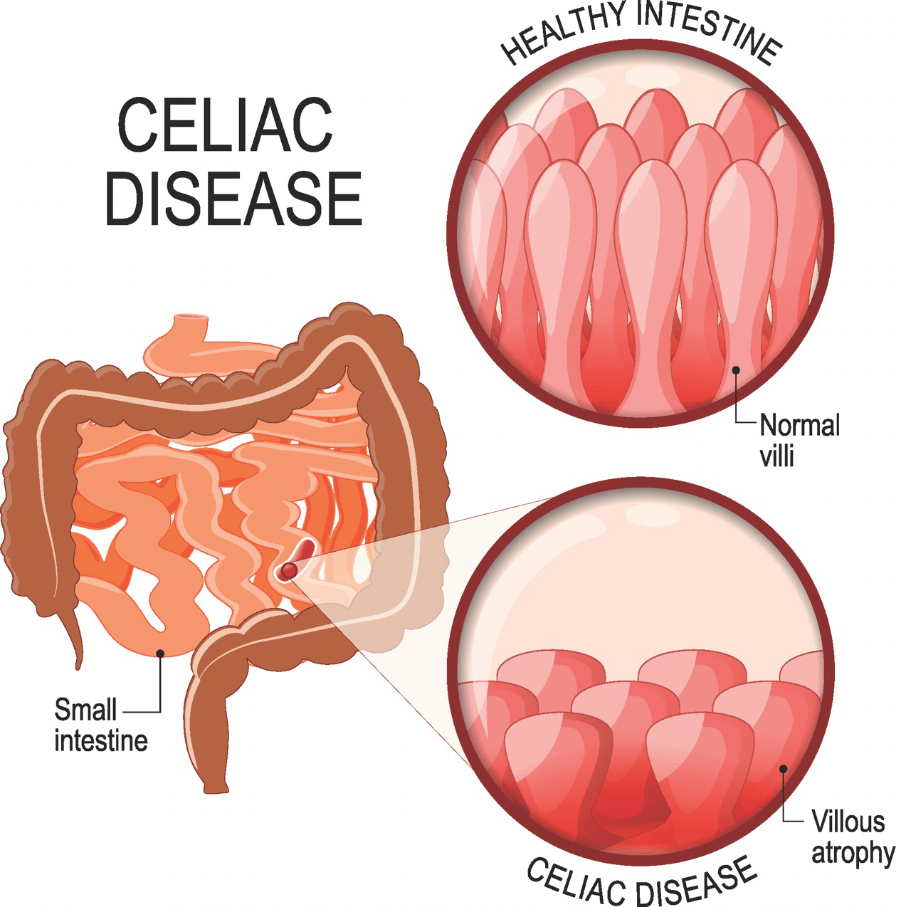 Coeliac disease