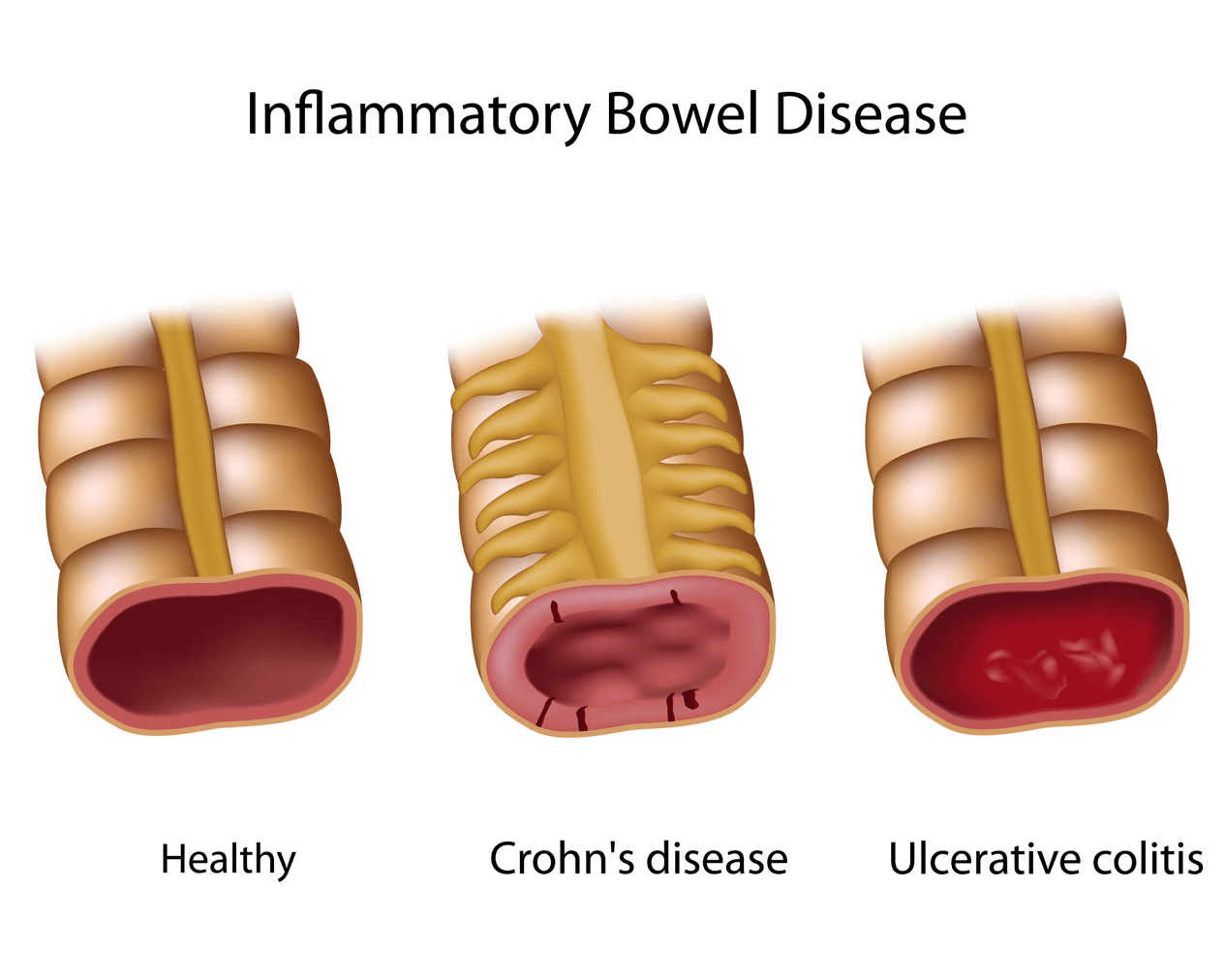 Crohn’s disease