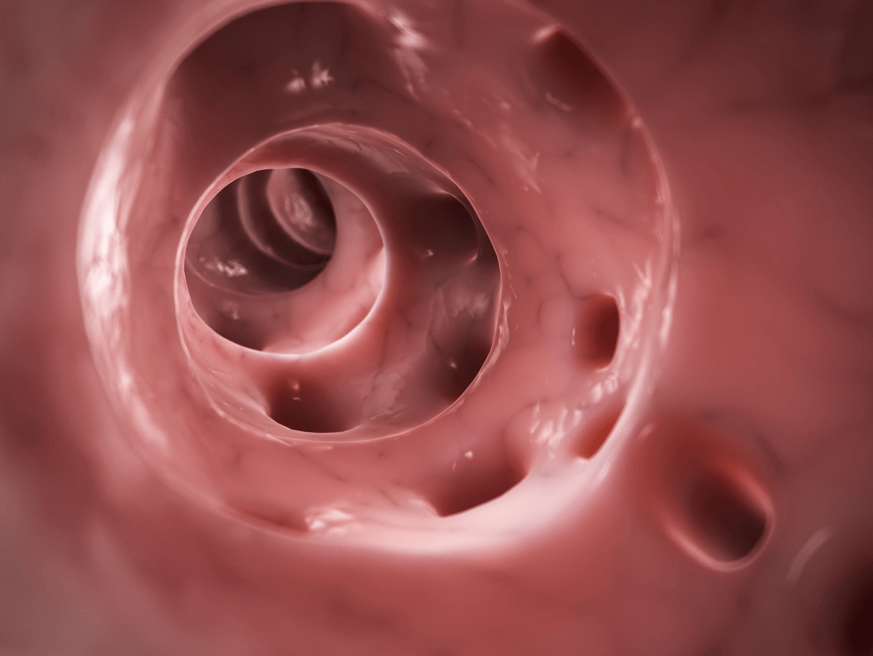 Diverticular disease