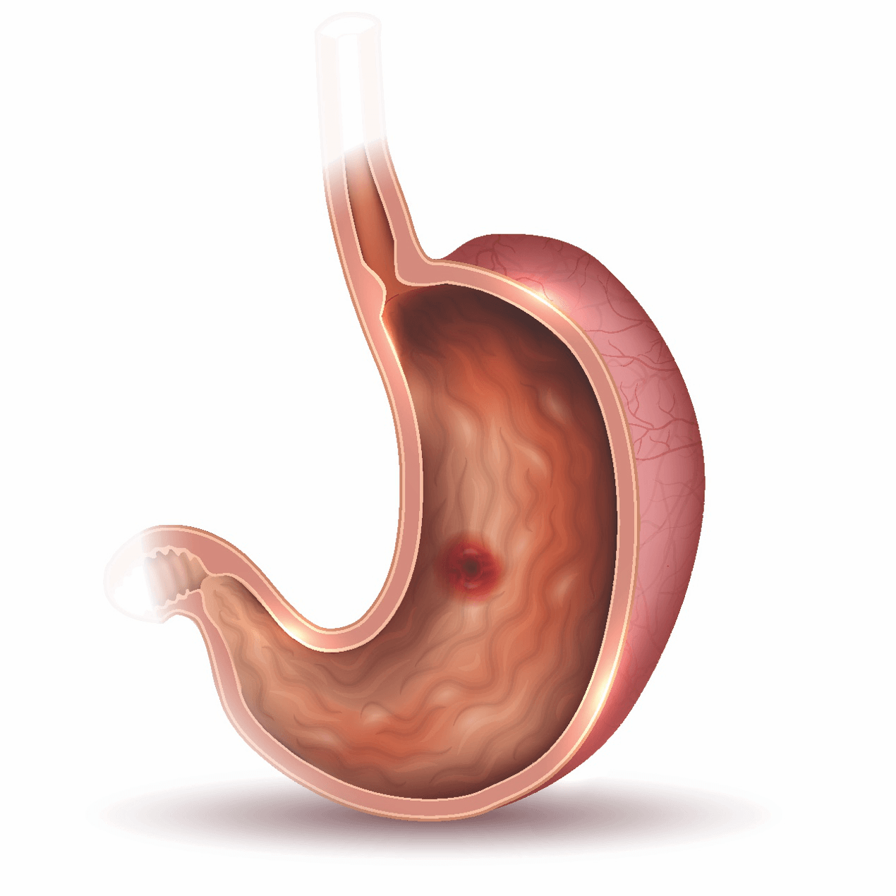 Peptic ulcer disease