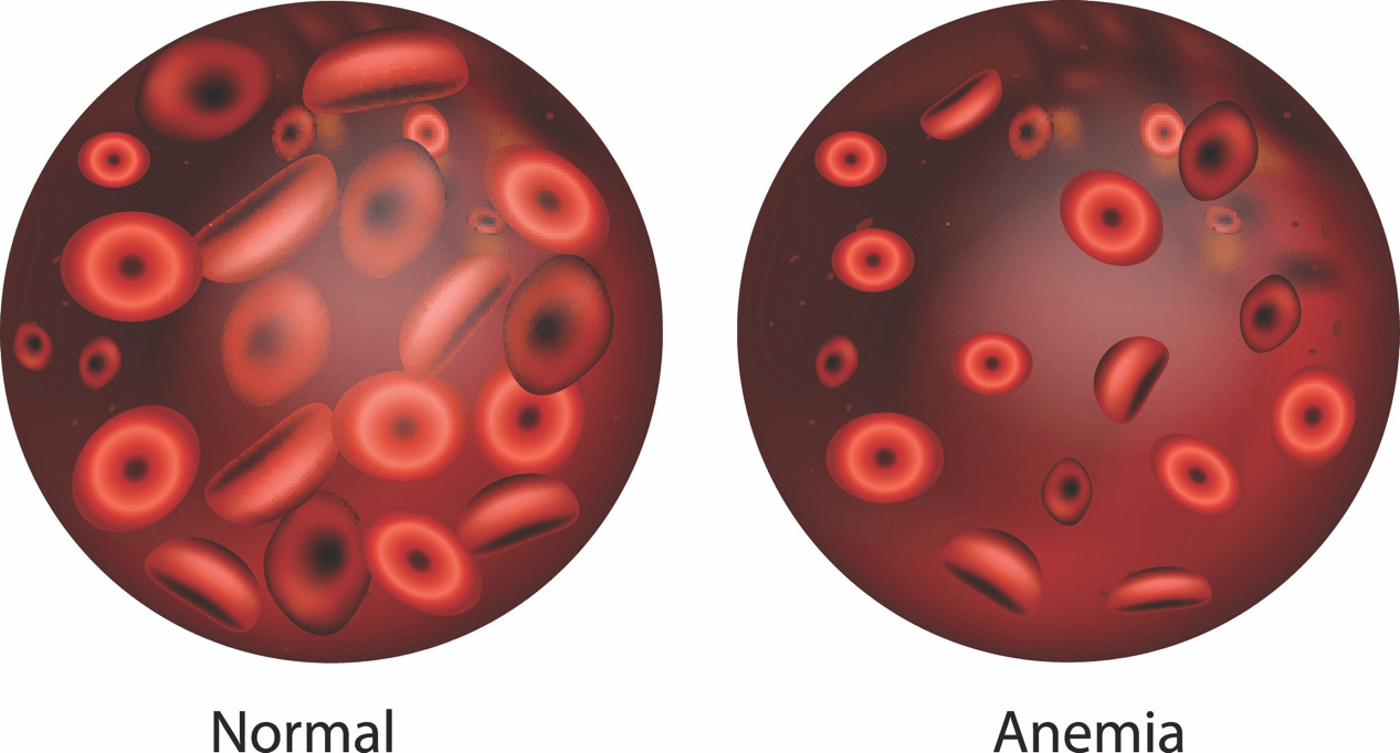 Low Blood Iron Levels