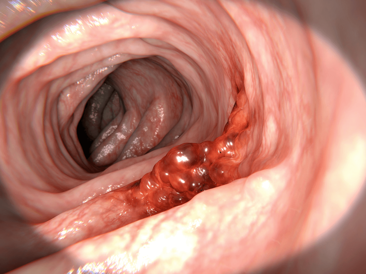 Screening for bowel/gastrointestinal cancer