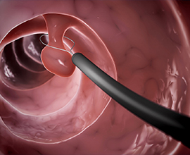 Therapeutic polypectomy