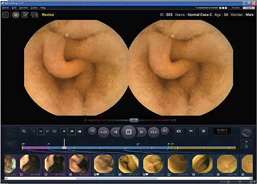 Wireless video capsule endoscopy