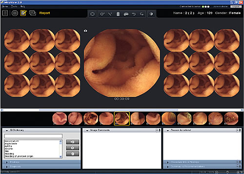 Wireless video capsule endoscopy